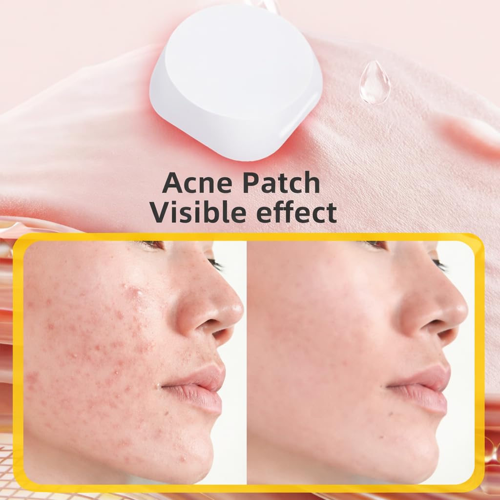 UCRAVO LED Acne Treatment Patch for Pimples & Breakouts | Acne Bye LED Therapy Patch with Blue Light Technology | Reusable Acne Spot Corrector for Face | Fast Pimple Reduction Device | 6 Pcs Pack