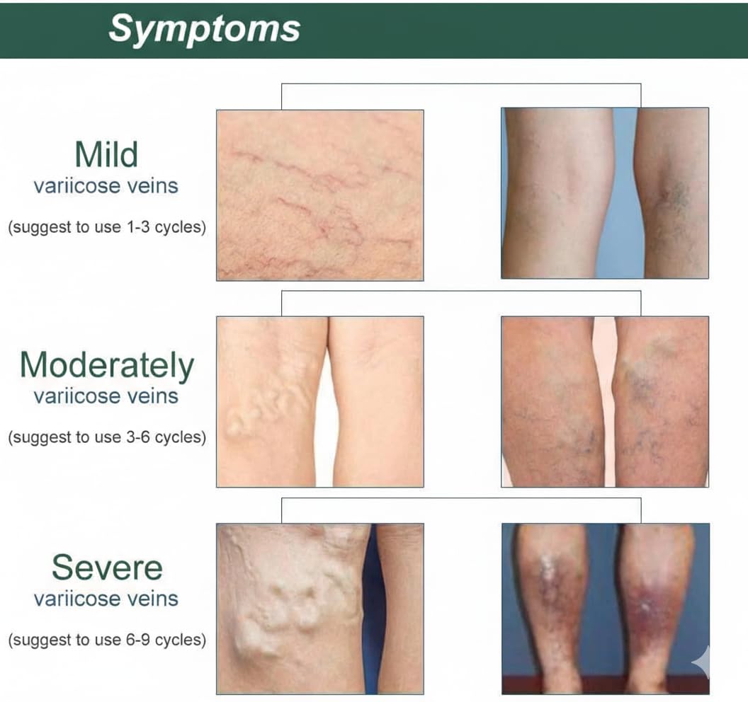 UCRAVO Varicose Veins Patch 36 PCS Herbal Vein Care Patch for Leg Swelling,Spider Veins,Muscle Pain Relief,Improve Blood Circulation,Deep Vein Support,Skin Friendly Pain Relief Patch for Men & Women