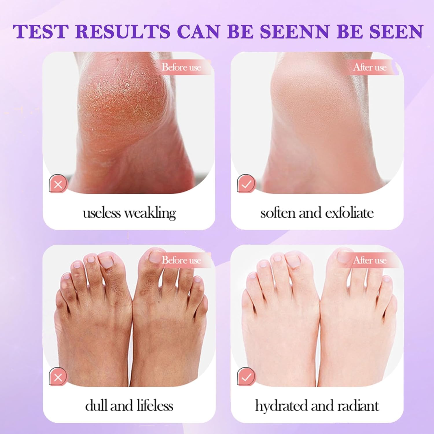 UCRAVO Purple Foot Peeling Mask for Dead Skin Removal, Exfoliating Foot Mask Peel for Cracked Heels, Callus Remover Socks, Baby Soft Feet Spa Treatment for Men & Women (1 Pair)